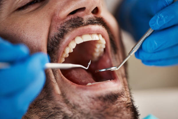 Best Emergency Dentist for Lost Fillings or Crowns in Lithia Springs, GA